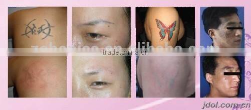 HY-1 hot product tatoo removal nd yag laser price for laser tattoo removal