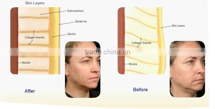 RF skin care equipment portable beauty salon equipment HS 530 by shanghai med apolo medical technology