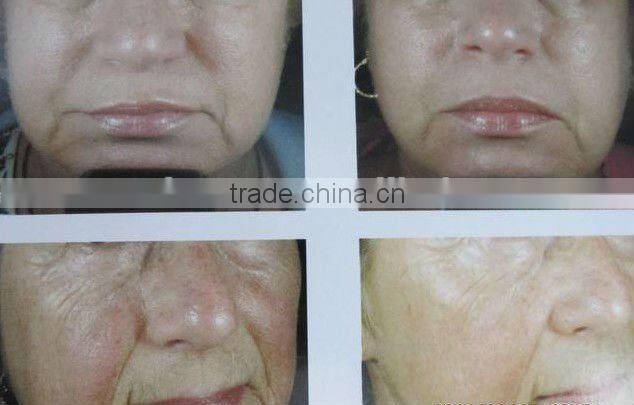 Mini RF Electrolysis machine for hair removal C003