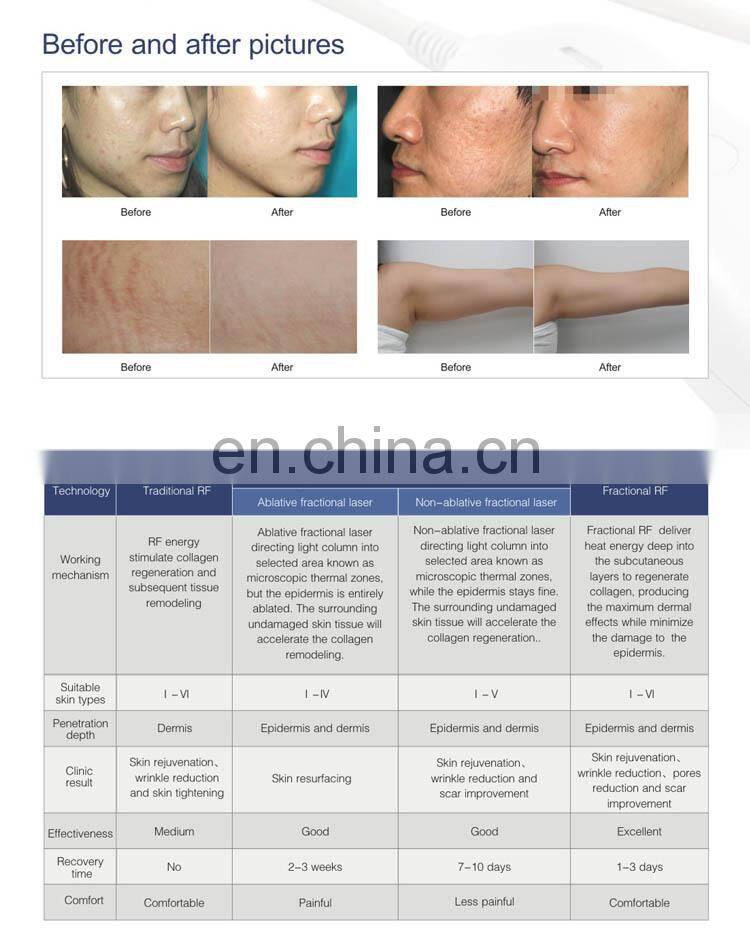 Great quality rf fractional micro needle / fractional rf microneedle / fractional rf