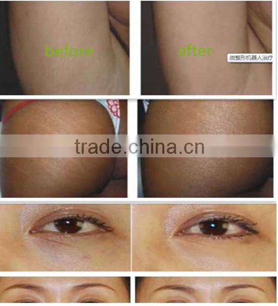 zhengjia medical co2 carboxy therapy CDT machine for wrinkle remover