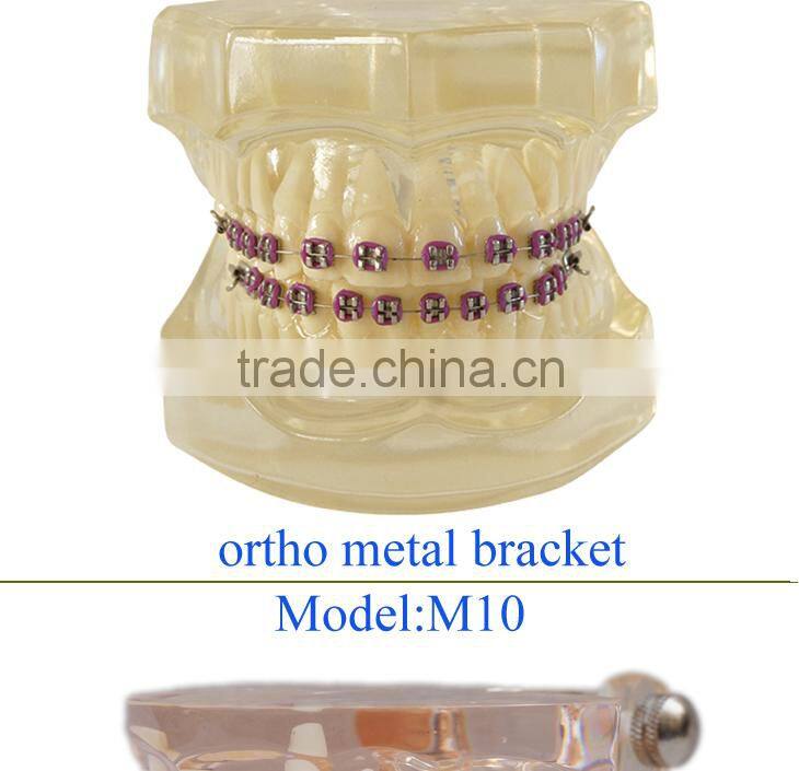 Popular Transparent Plastic Pathologic Dental Implant Model for study