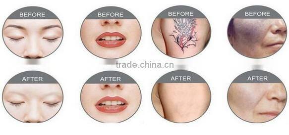 Vertical Q Switched Nd Yag Laser for all Color Tattoo Laser Removal Machine