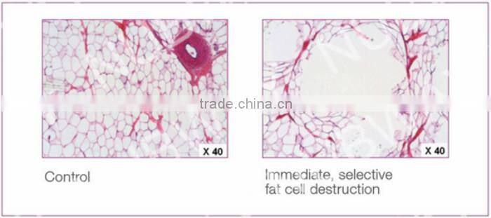 hifu body lift multifunction slimming beauty machine