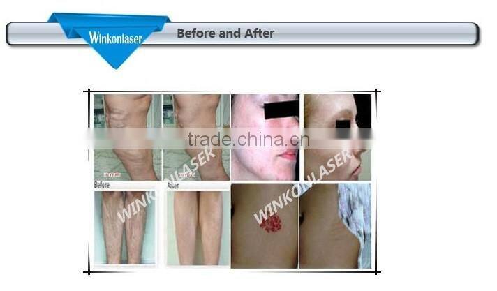 Best China hot sale!! Super Fast Color Touch Screen Nd Yag Long Pulse Laser 10HZ