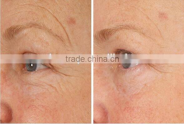 2016 hot 1200 needles body roller 3in1 derma cosmetic roller kit for dermatology