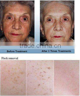 Portable ipl+rf/elight hair removal and skin rejuvenation equipment-C002