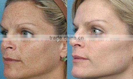 Portable Intense Pulsed Light IPL Acne/Hair Removal Device