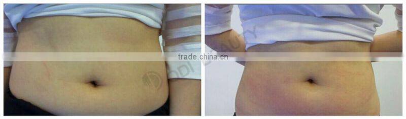 2015 New arrival high quality OD S90 3 in 1 vacuum liposuction ultrasonic cavitation best fast slimming machine