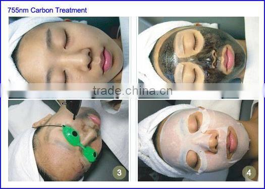 2015 Newest Tattoo Laser Removal Machine Q-Switch ND:YAG Device