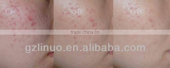 2013-2017 the most professional 540 needle mini vibrating roller massager (very HOT in Europe!!!!!!!!!!!)