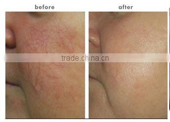 professional diode laser blood vessels removal spider vein / vascular removal equipment