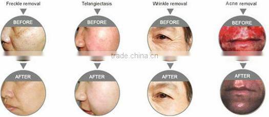 Effective Bio-light therapy!!!! high quality skin rejuvenation ipl/rf/e light/led/pdt/laser