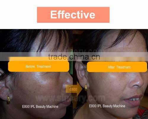 3 Handles rf+ipl laser hair removal machine for sale lowest price