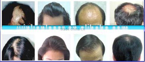 cool laser hair regrowth