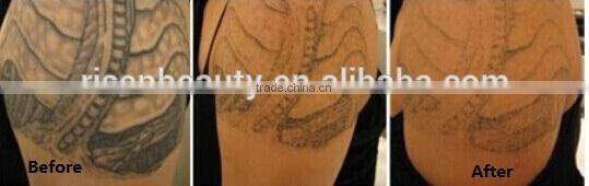 Best Price Q Switch Tattoo Removal laser for sale