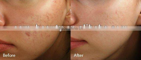 Mini home device PDT LED for skin rejuvenation