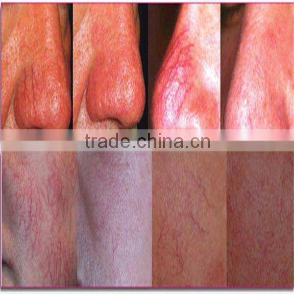 Effective remove spider veins beauty equipment red face red nose spider veins