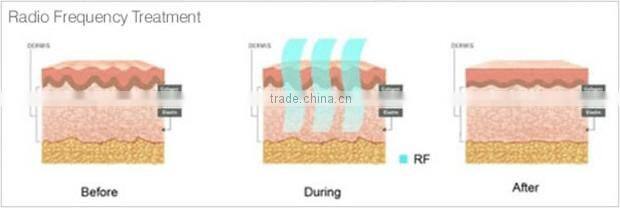 Cryolipolysis Cavitation RF Skin tightening Face Lifting Machine