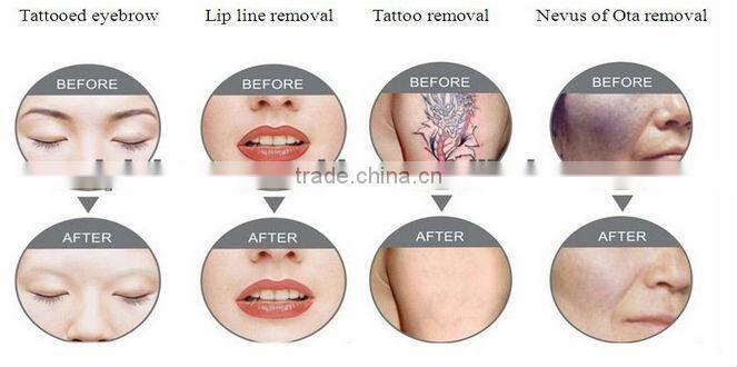 nd yag laser q switch/nd yag laser beauty machine/nd yag laser