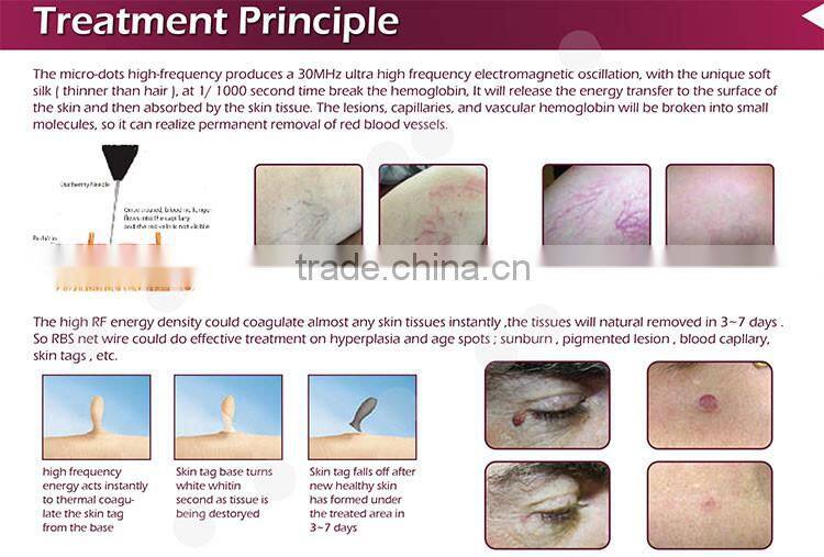 2017 New innovative technology 30 Mhz radio frequency painless facial vein treatment in legs