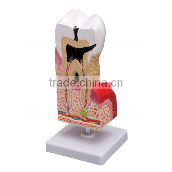 Handmade Pathology Plastic Teeth Tooth Model