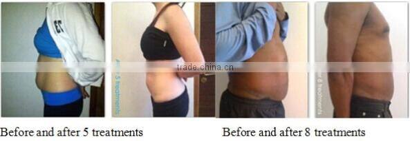 Non-Invasive three Handles Cryoshape cellulite reducer/fat melting machine