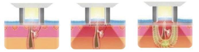 IPL rf laser hair removal equipment, Global hot sale elight ipl rf laser