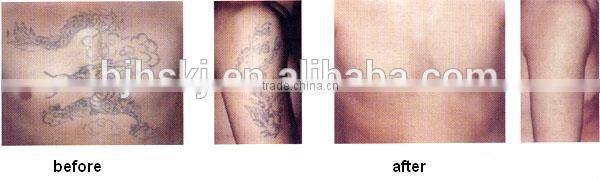 New Designed q switch nd yag laser tattoo removal machine price/ tattoo removal laser