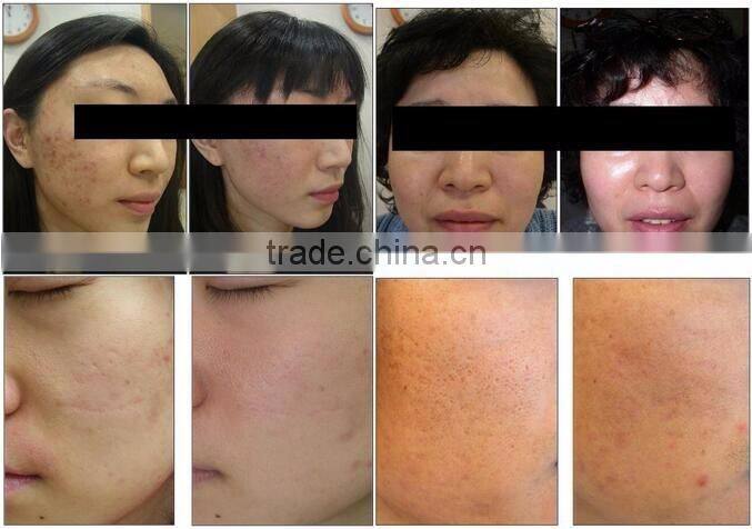 Hot selling professional 1550 diode laser acne scar removal anti aging