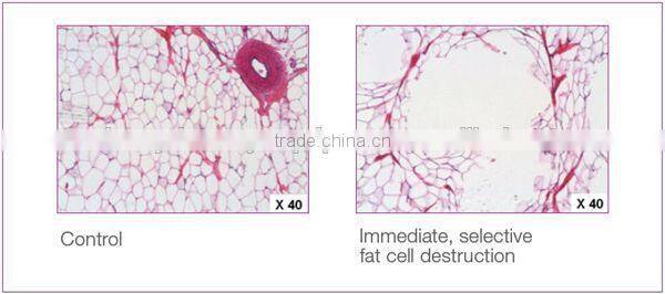 Ultrashape HIFU Body Slimming Machine ultrasonic lipolysis slimming machine