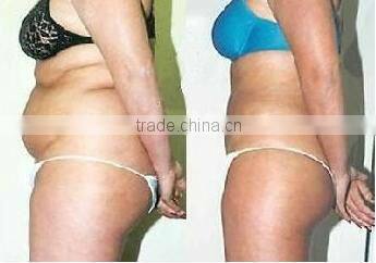 2016 long lasting effects ultrasonic liposuction slimming machine