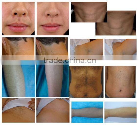 portable 810nm diode laser hair removal / depilation diode laser hair removal / laser diode 810nm portable