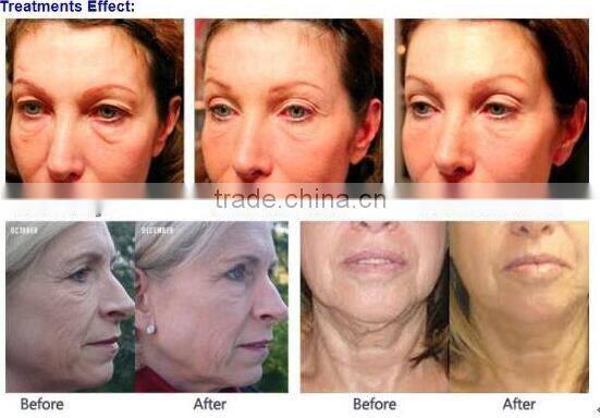 AYJ-T29B thermagic equipo rf machine have cooling system