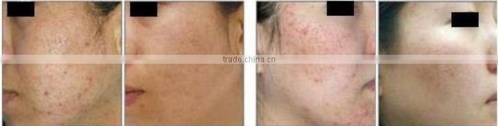 Top technology vaginal tightening RF CO2 fractional laser beauty machine factory price OY-11