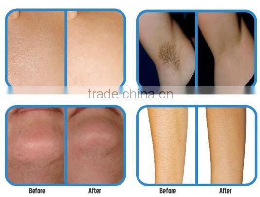 Best selling products E-light hair removal machine