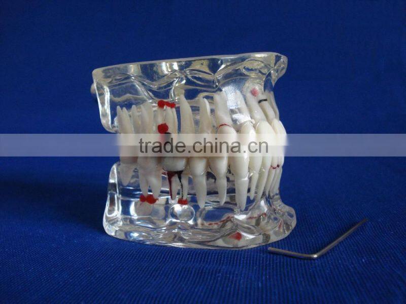 Dental adult pathological dentition model DEA-48 teeth model teaching demonstration