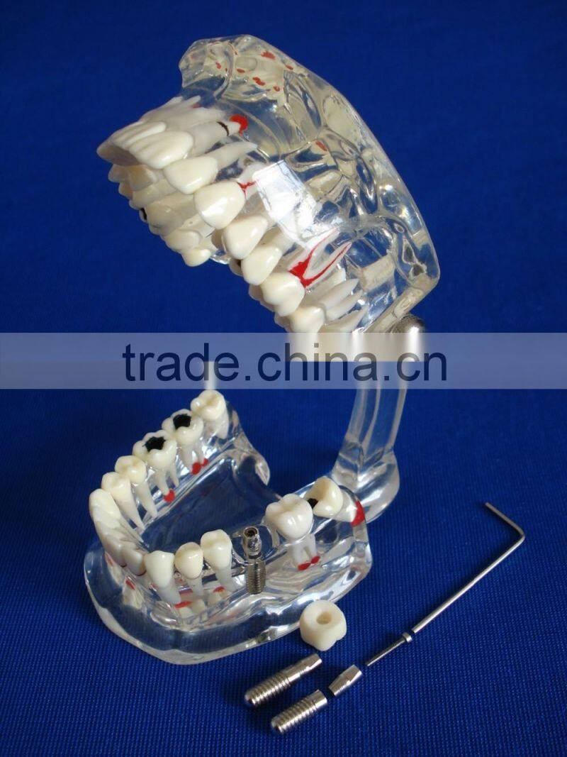 Dental adult pathological dentition model DEA-48 teeth model teaching demonstration