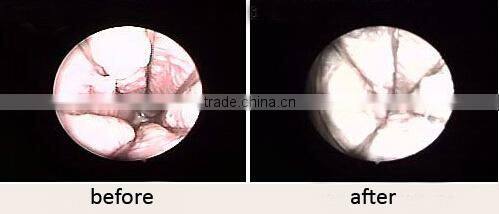 CO2 fractional laser vaginal tightening/laser vaginal rejuvenation equipment