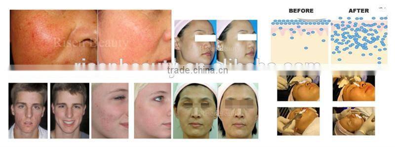 cellulite roller massage therapy machine derma pen derma stamp