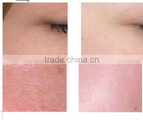 Langdy CE Certificated Water Oxygen Jet Peel Machine with factory direct selling price