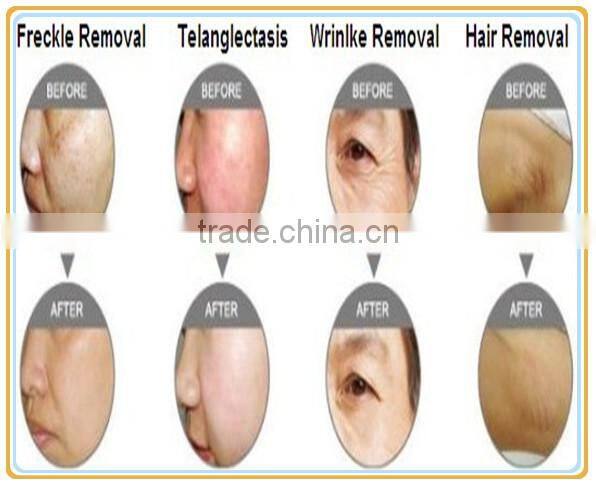 30 million shots!!!! Best sell SHR hair removal equipment, with CE certification laser machine