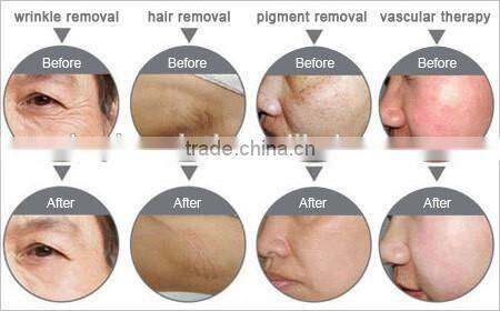 Factory price hair removal equipment with good results for sale