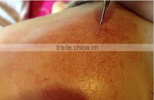 Rbs 30Mhz high frequency spider veins removal vascular therapy machine