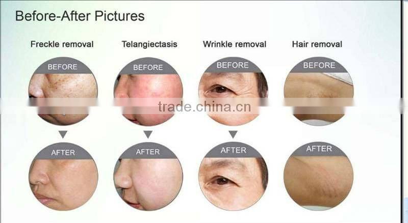 shr elight IPL Laser hair removal machine / CE approved cheapest SHR+E-light+IPL+RF Machine/ipl machine for home use