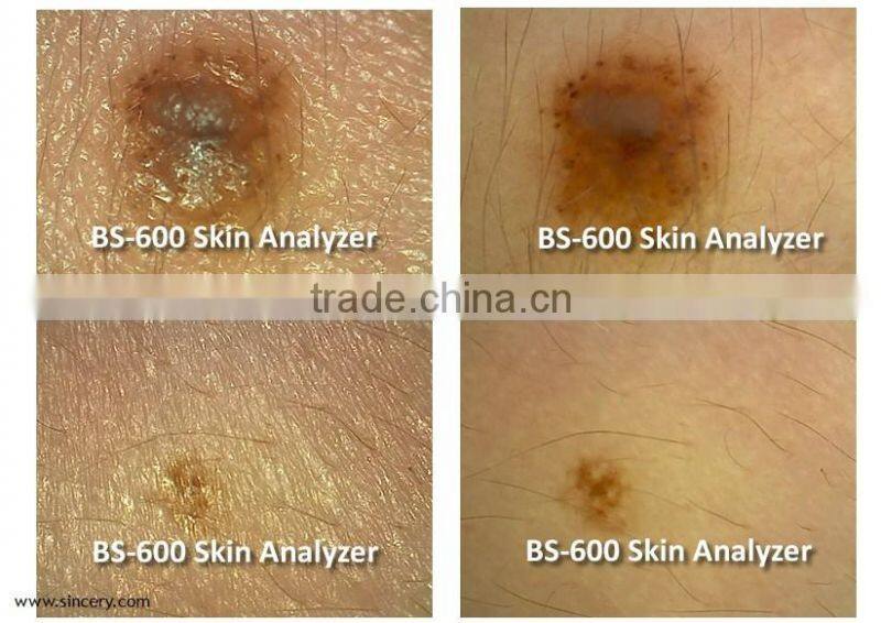 Home, salons and clinics using portable skin tightening skin analyzer