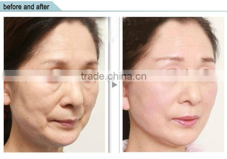 Portable salon machine / high intensity focused ultrasound for wrinkle removal / face lift 2016