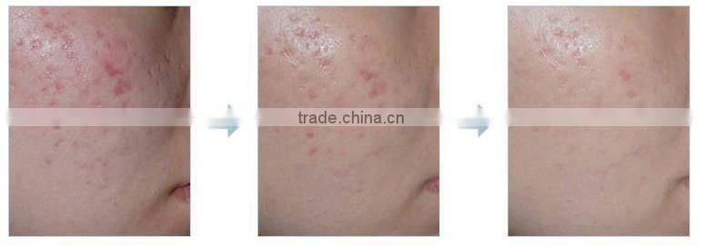 Cosmetic Facial Beauty Derma Roller Lessen Wrinkles,Pigment,Acne,Scar Treatment (LED Light+Changeable Head)