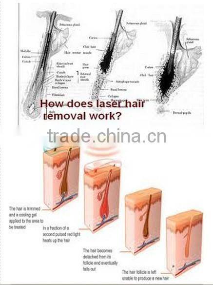 808 diode laser equipment,portable 808nm diode laser hair removal home use,diode laser lightsheer