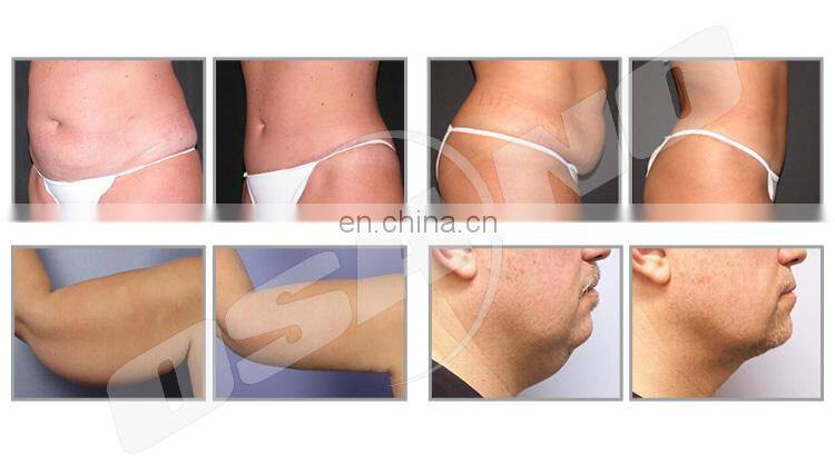 Best new product CE approved fast slimming machine lipolaser fat loss beauty equipment